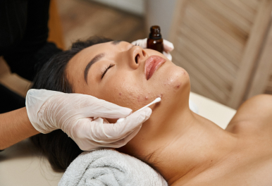 Acne Facial Merbeauty Spa